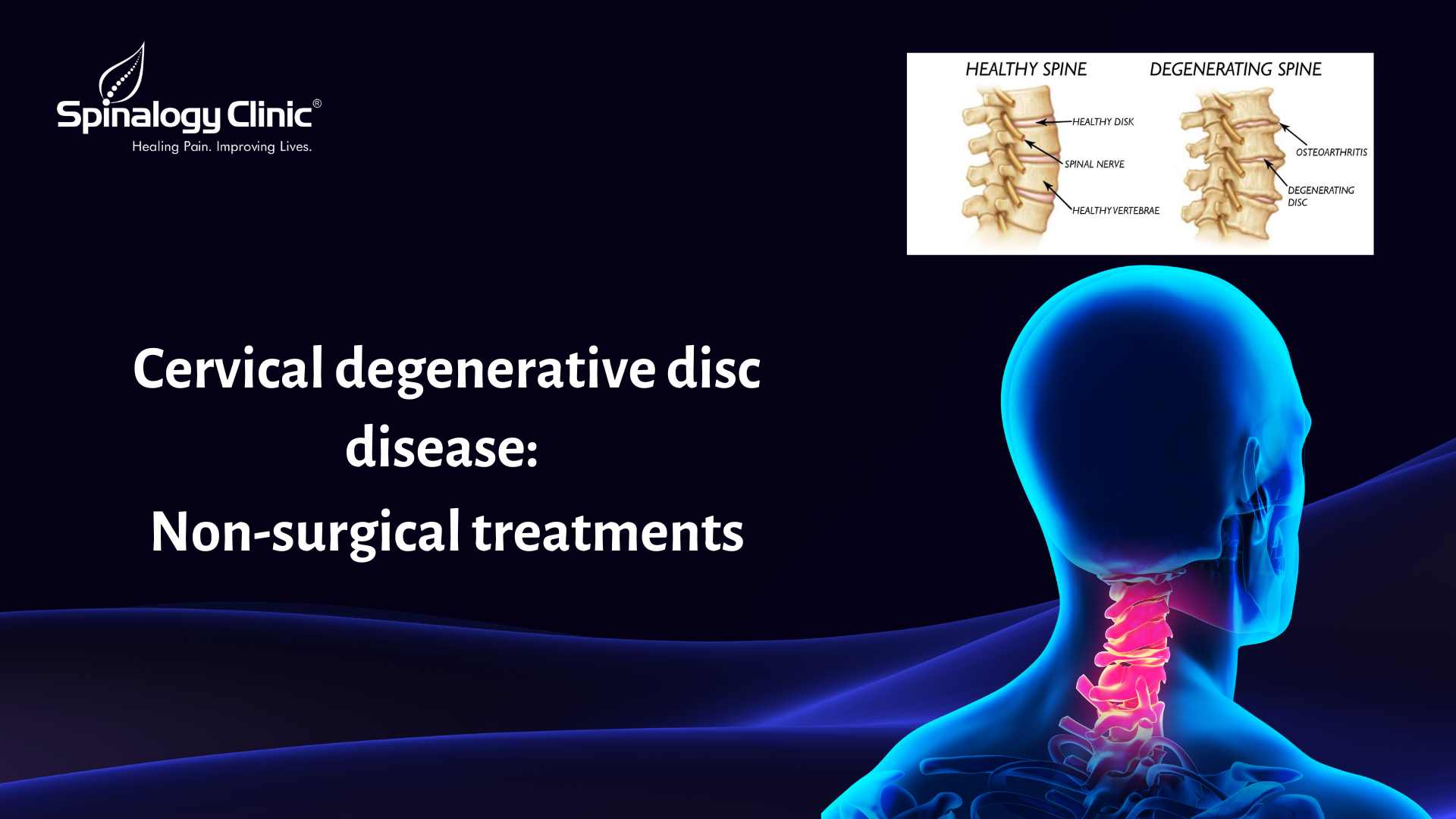 Cervical Degenerative Disc Disease: Non-Surgical Treatments